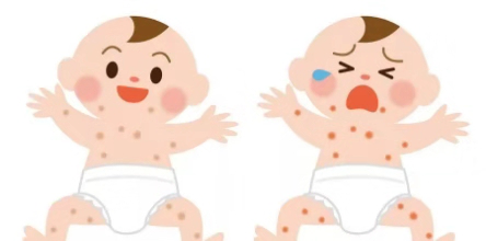 成都湿疹 成都湿疹