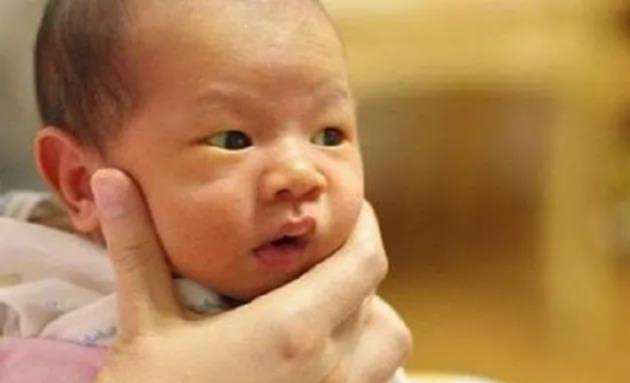 成都小儿黄疸 成都小儿黄疸